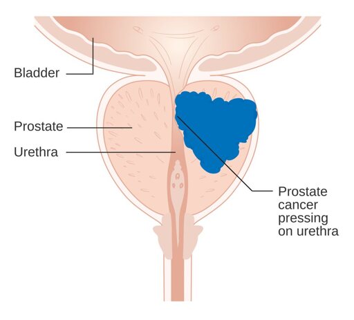 New Music Video Released for Prostate Cancer Awareness Month