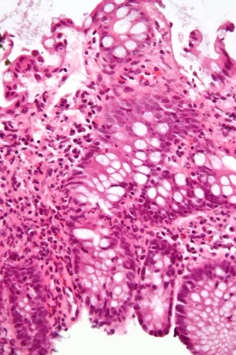New Microscope Could Unlock Root Cause of Incurable Bowel Disease